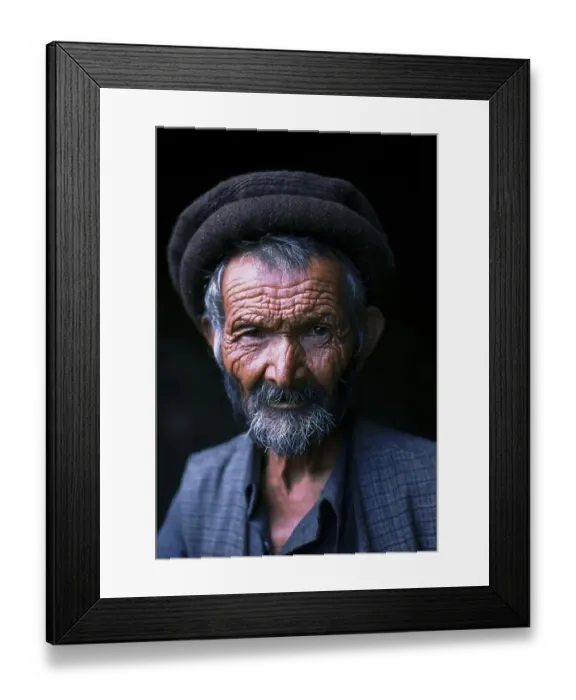 Framed Print : Man suffering from cretinism, mental and physical disability