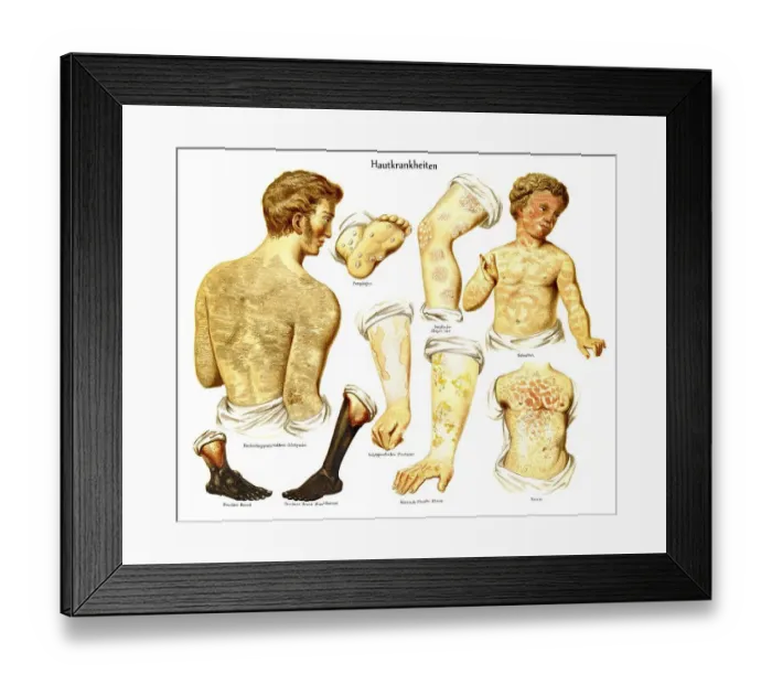 Framed Print : Historic illustration of skin diseases