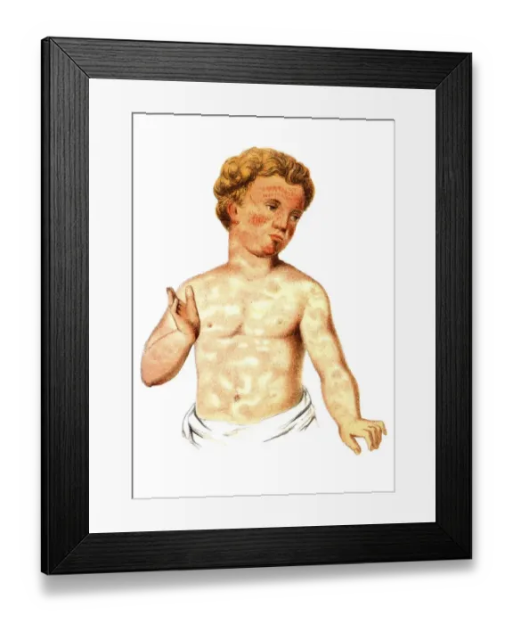 Framed Print : Scarlet fever, illustration, Meyers Konversations-Lexikon encyclopedia