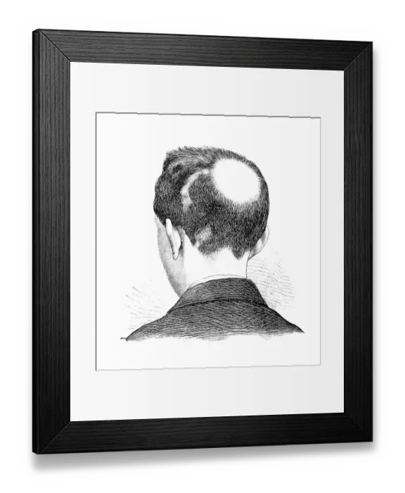 Framed Print : Alopecia areata (AA) is a condition affecting humans Framed Print : Alopecia areata (AA) is a condition affecting humans