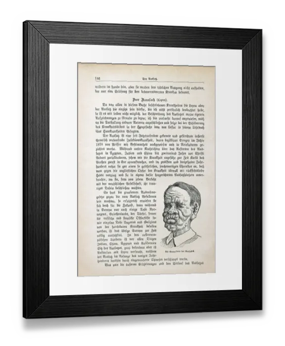 Framed Print : The nodal form of leprosy leprosy