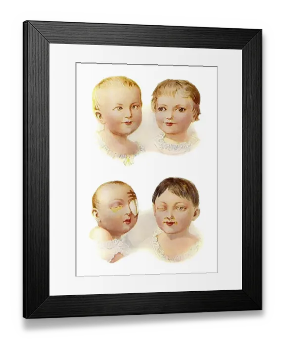Framed Print : Images from a medical book, children's eye diseases Framed Print : Images from a medical book, children's eye diseases