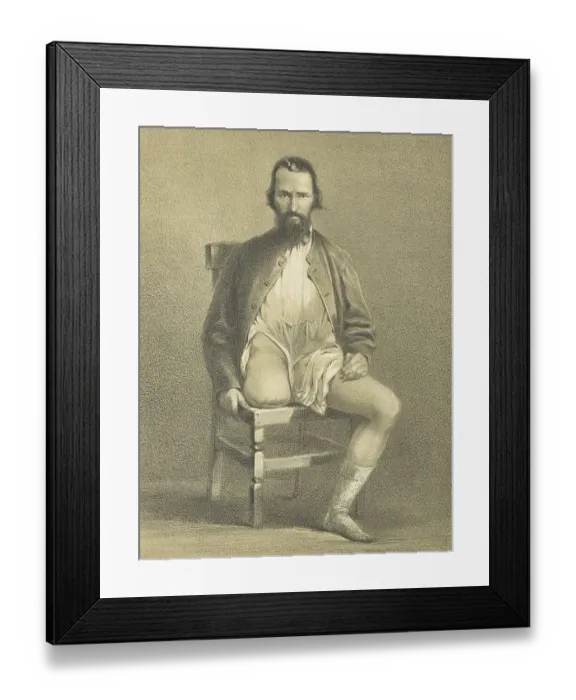 Framed Print : Medicine, Anatomy, Amputation of the Hip Joint and Leg in Military Surgery