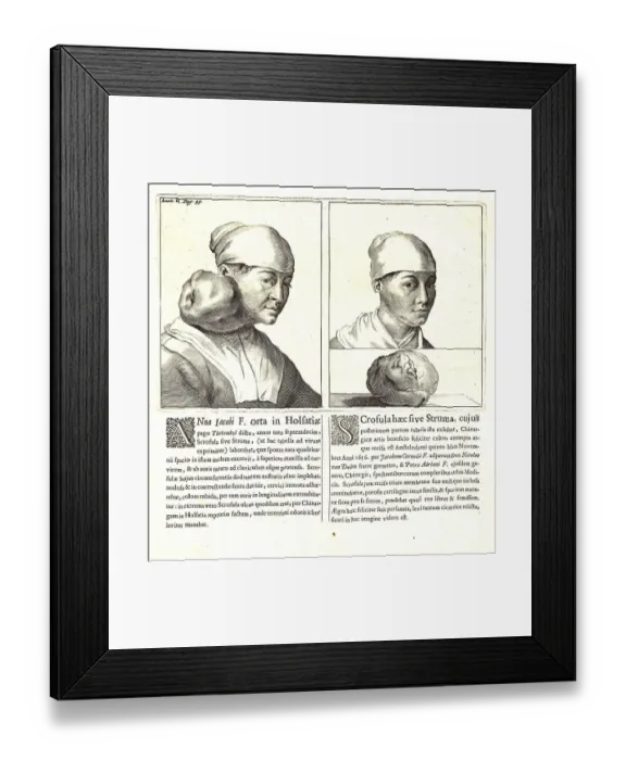 Framed Print : Medicine, Anatomy, Anneke Jacobs van Thetenbul in front of and after surgery on a tumour