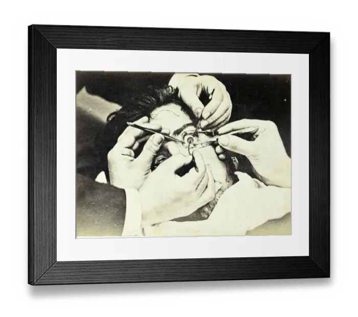 Framed Print : Medicine, Anatomy, Moving part of the iris during eye surgery Framed Print : Medicine, Anatomy, Moving part of the iris during eye surgery