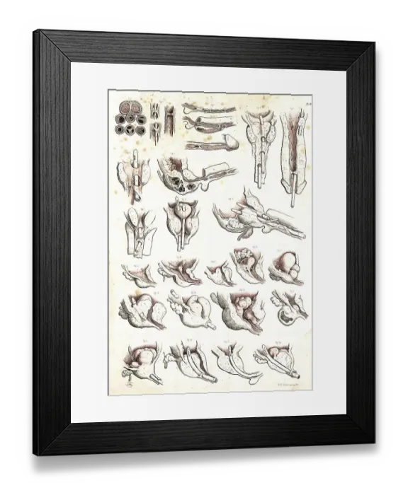 Framed Print : Medicine, Anatomy, Operation on a male urethral obstruction