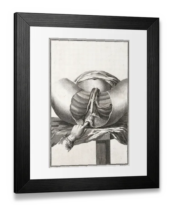 Framed Print : Medicine, Anatomy, Surgery, Examination of the Perineum
