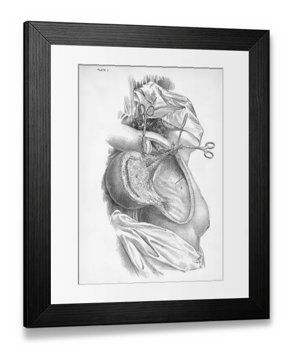 Framed Print : Medicine, anatomy, surgery, breast cancer