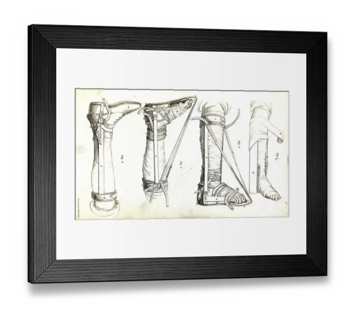 Framed Print : Medicine, Anatomy, Surgery, Apparatus for the correction of clubfoot after surgery