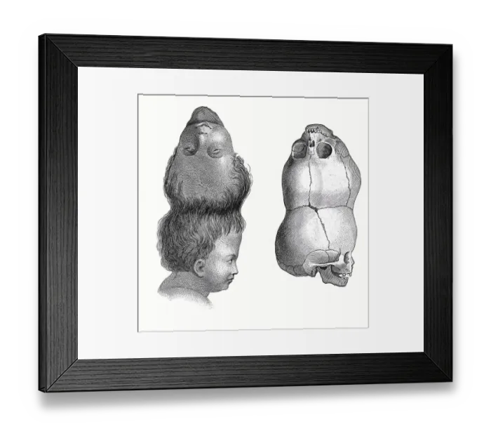 Framed Print : Medicine, Anatomy, Siamese twins