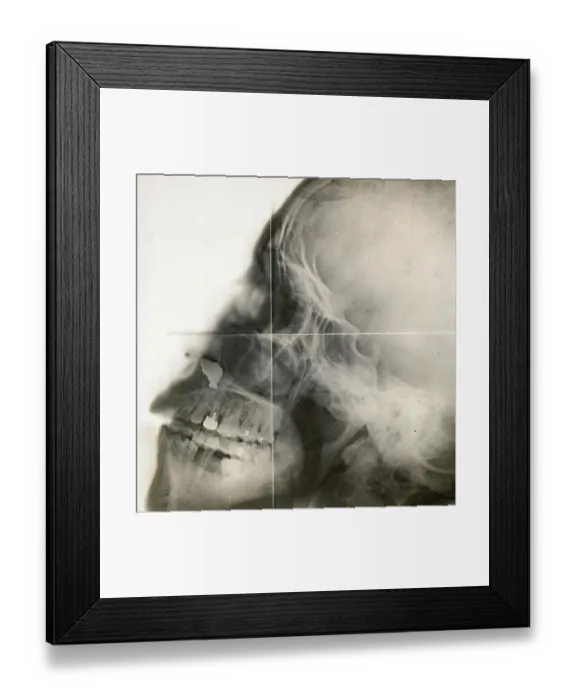 Framed Print : X-ray of a human skull, c. 1915 Framed Print : X-ray of a human skull, c. 1915