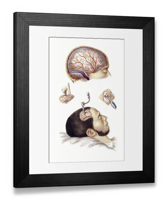 Framed Print : Medicine, Surgery, The trepanation Framed Print : Medicine, Surgery, The trepanation