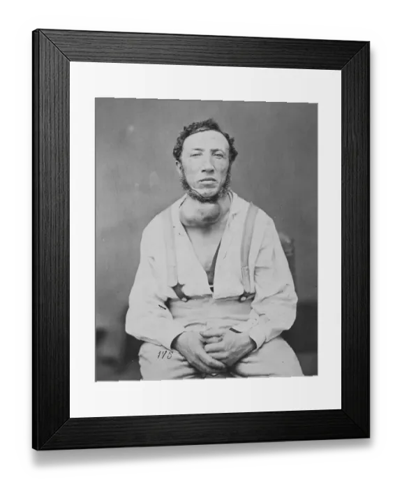 Framed Print : Joseph Brown, Aneurysm of the Innominate Artery