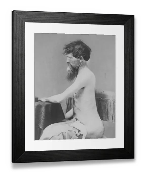 Framed Print : War-wounded Private John Bar, recovering from a penetrating abdominal wound with fracture of the left os innominatum Framed Print : War-wounded Private John Bar, recovering from a penetrating abdominal wound with fracture of the left os innominatum