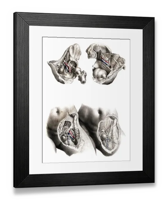 Framed Print : Medicine, human anatomy, femoral hernia