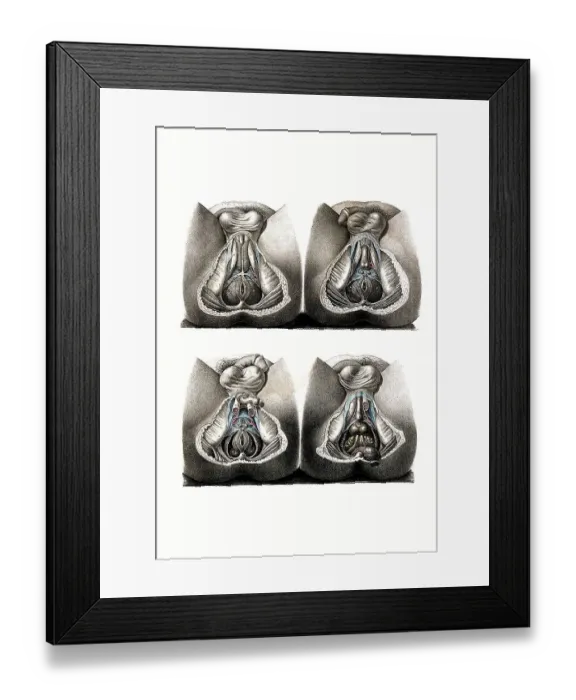 Framed Print : Human anatomy, medicine, dissection of the perinaeum Framed Print : Human anatomy, medicine, dissection of the perinaeum