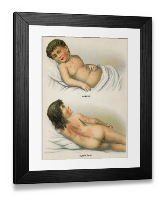 Framed Print : Measles, Scarlet fever, health counselor