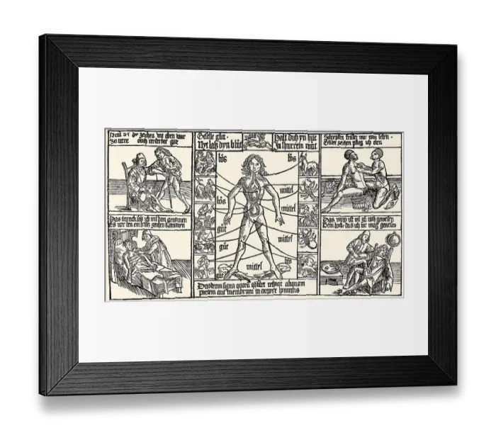Framed Print : Medicine treatment, bloodletting procedure