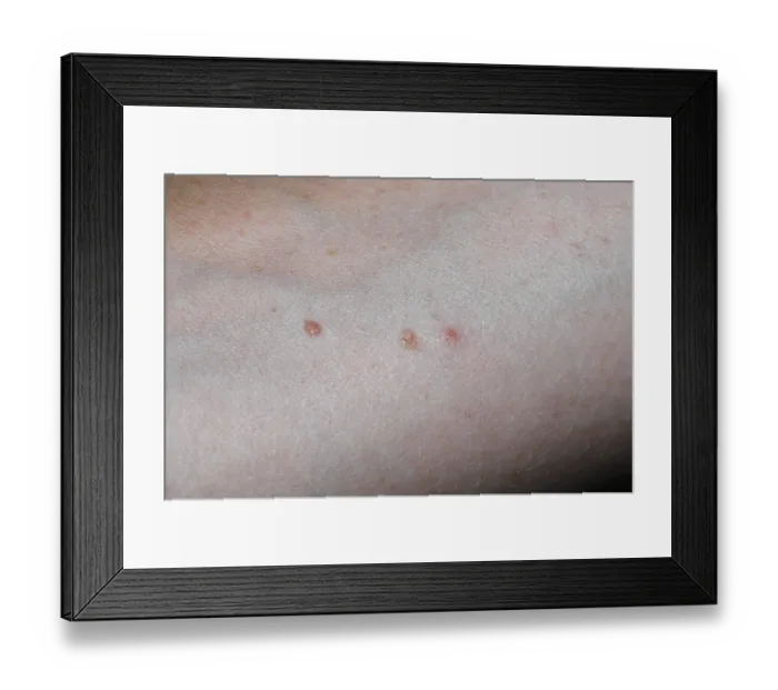 Framed Print : Flea bites Framed Print : Flea bites