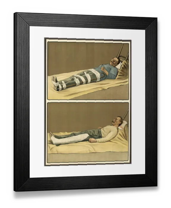 Framed Print : First aid, emergency treatment for broken bones