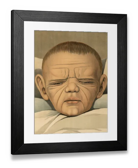 Framed Print : Medical illustration, clinical picture