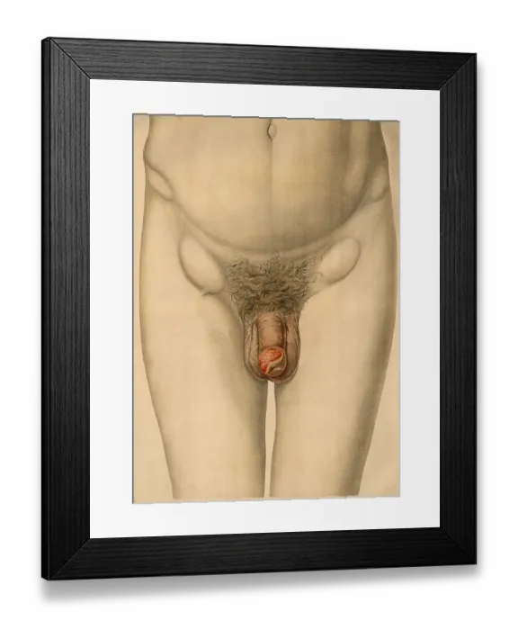 Framed Print : Medical illustration, clinical picture