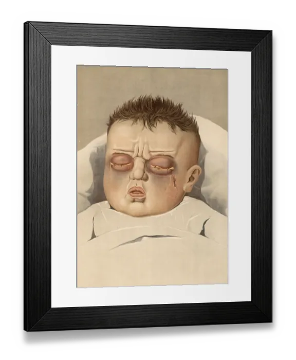 Framed Print : Medical illustration, clinical picture