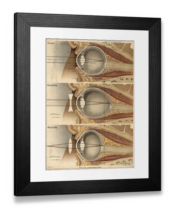 Framed Print : Medical illustration, defective vision of the human eye