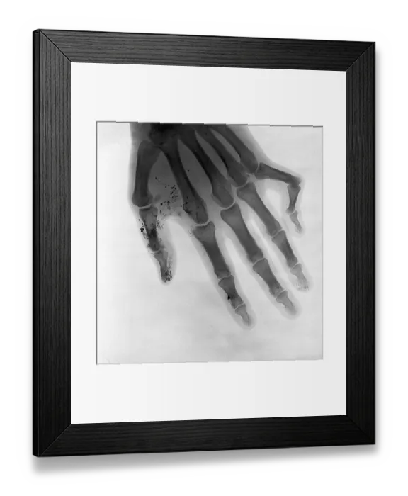 Framed Print : Bone of a hand, deformed little finger Framed Print : Bone of a hand, deformed little finger