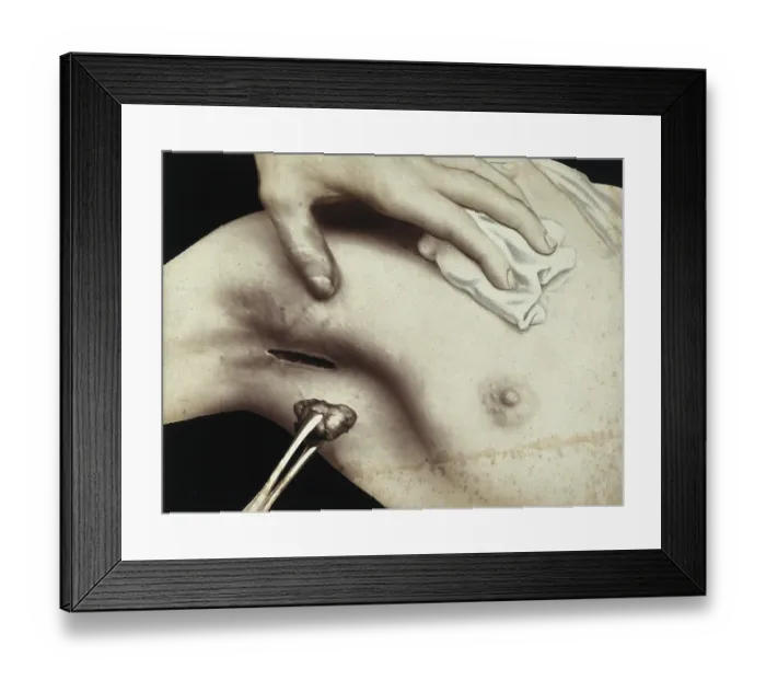 Framed Print : Patient, surgery, breast surgery Framed Print : Patient, surgery, breast surgery