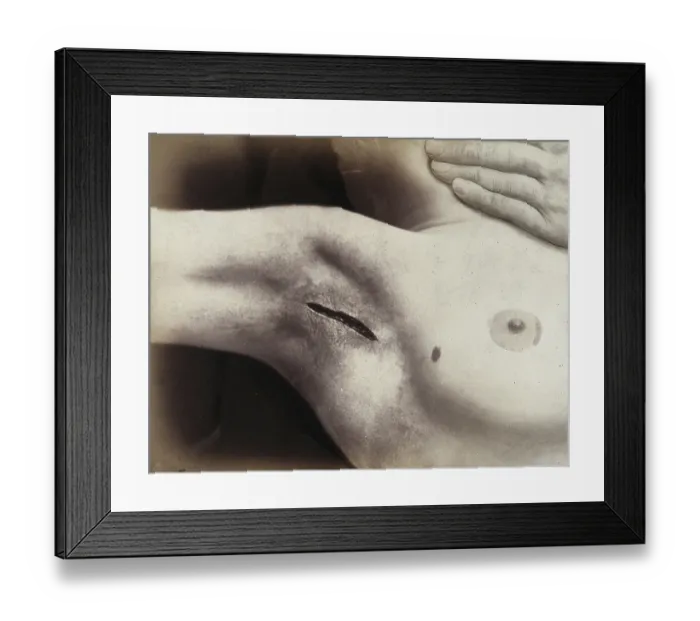 Framed Print : Patient, operation, an cut in the armpit to operation silverware Framed Print : Patient, operation, an cut in the armpit to operation silverware