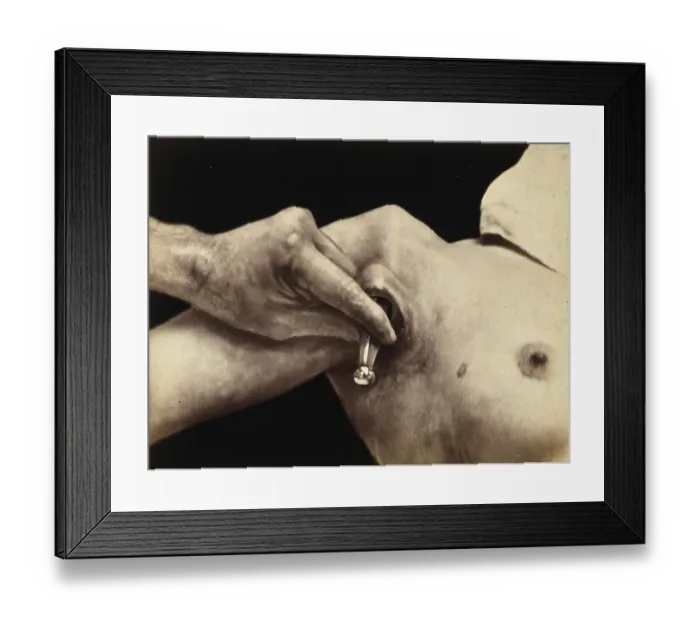 Framed Print : Patient, operation, a surgical instrument made of metal is inserted in an incision in the armpit