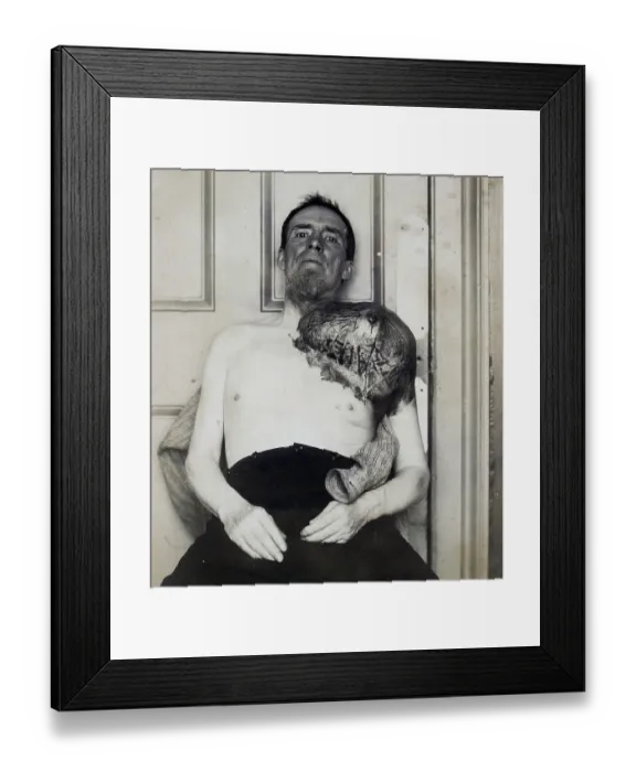 Framed Print : Bone cancer, malignant tumor, sarcoma