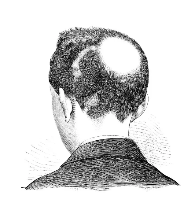 Framed Print : Alopecia areata (AA) is a condition affecting humans Framed Print : Alopecia areata (AA) is a condition affecting humans