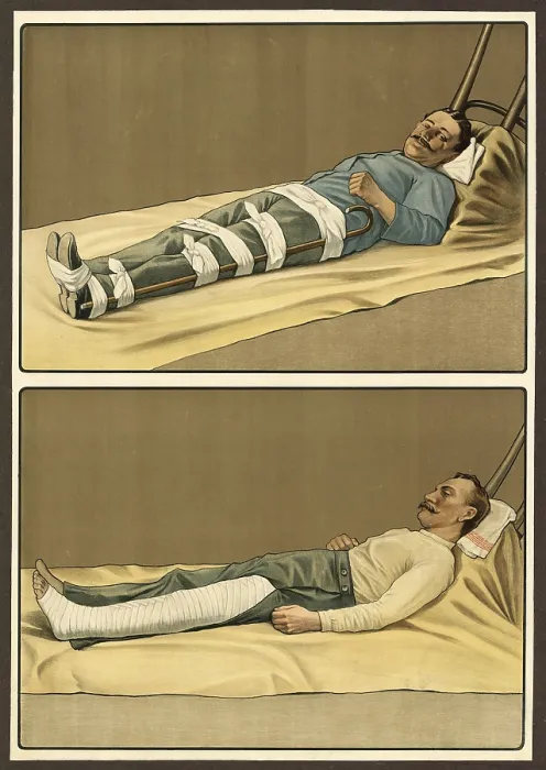 Framed Print : First aid, emergency treatment for broken bones