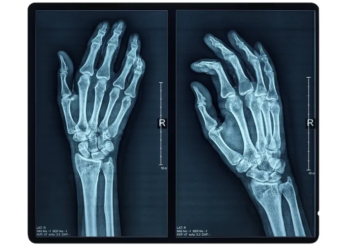 Framed Print : Hand X-ray of an adult female