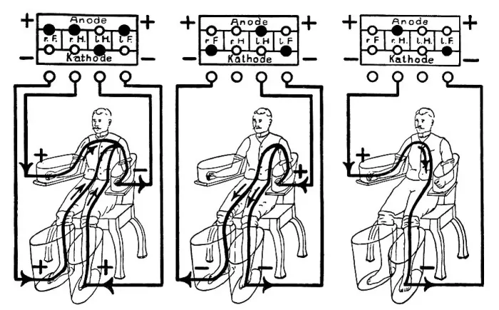 Framed Print : An illustration of a patient being treated with a four cell Schnee Bath