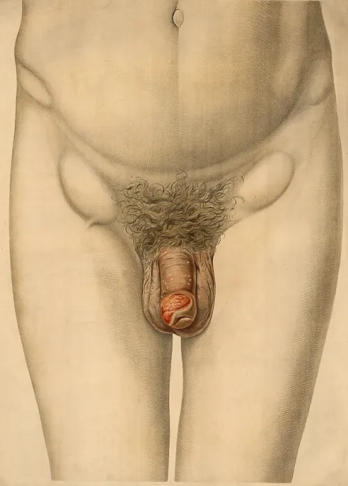 Framed Print : Medical illustration, clinical picture