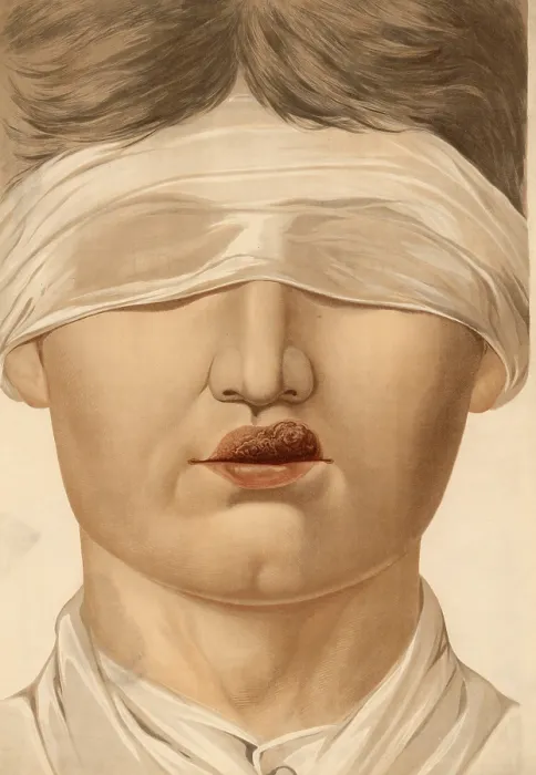 Framed Print : Medical illustration, clinical picture