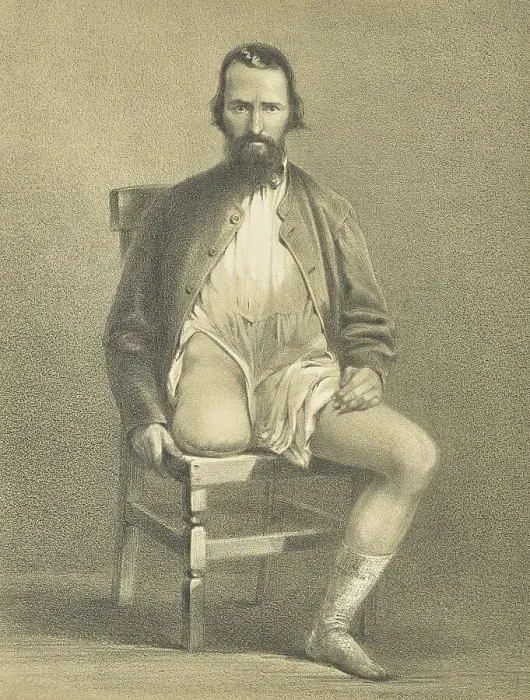 Framed Print : Medicine, Anatomy, Amputation of the Hip Joint and Leg in Military Surgery