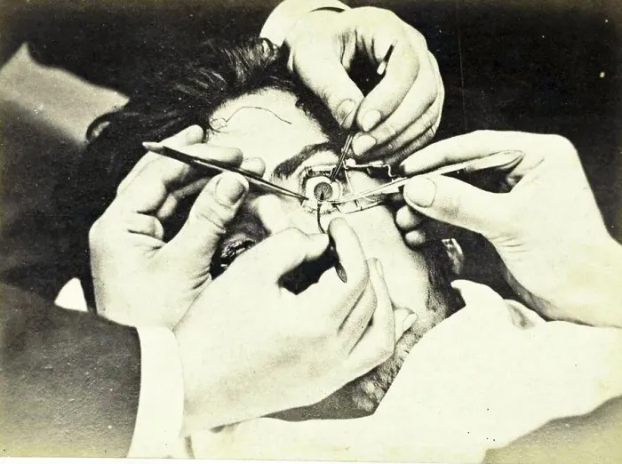 Framed Print : Medicine, Anatomy, Moving part of the iris during eye surgery Framed Print : Medicine, Anatomy, Moving part of the iris during eye surgery
