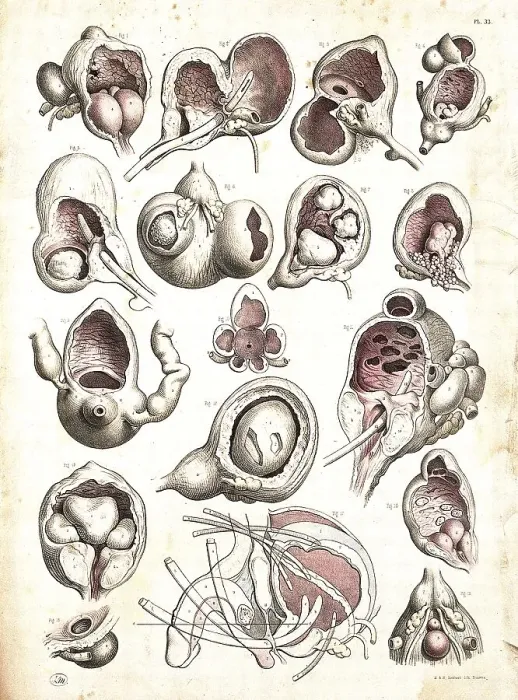 Framed Print : Medicine, Anatomy, Operation on a man's bladder