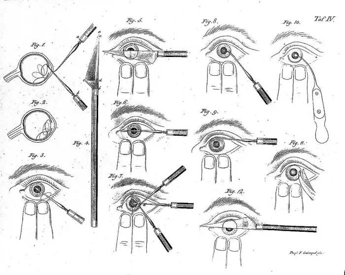 Framed Print : Medicine, Anatomy, Operation, Steps of an Ophthalmic Operation