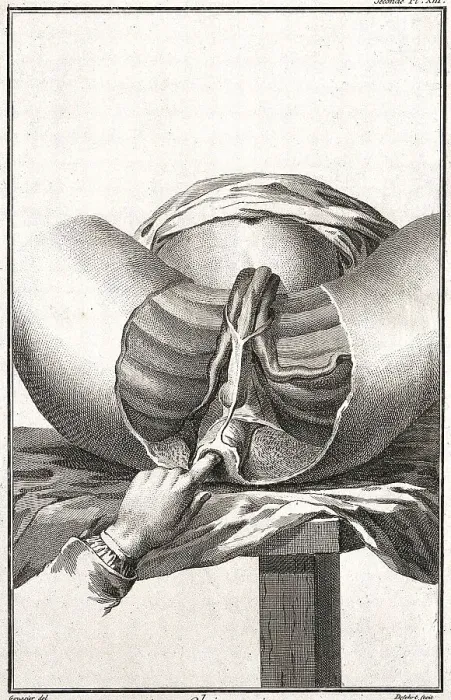 Framed Print : Medicine, Anatomy, Surgery, Examination of the Perineum