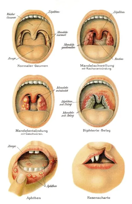 Framed Print : Mouth and throat diseases, health counselor