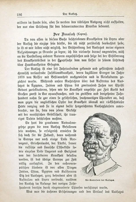 Framed Print : The nodal form of leprosy leprosy