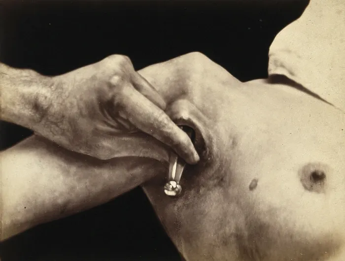 Framed Print : Patient, operation, a surgical instrument made of metal is inserted in an incision in the armpit