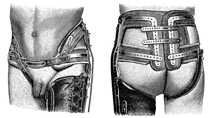 Framed Print : Pelvic girdle, brace, state of the art of therapeutic techniques Framed Print : Pelvic girdle, brace, state of the art of therapeutic techniques