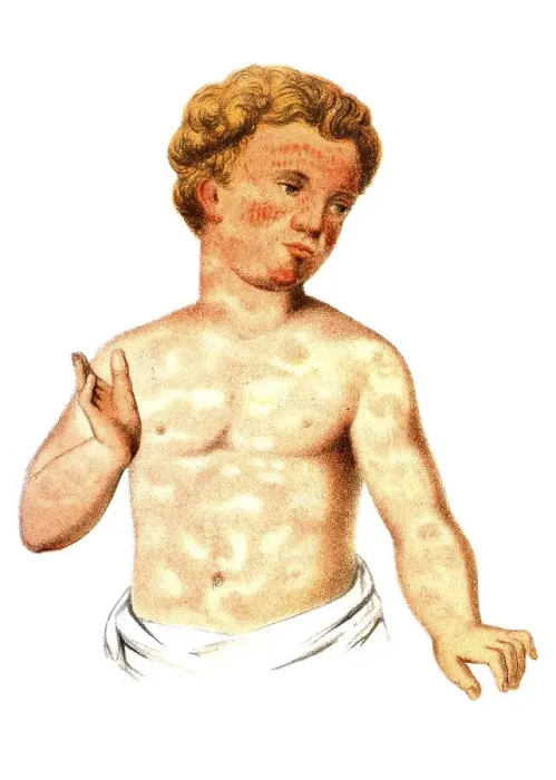Framed Print : Scarlet fever, illustration, Meyers Konversations-Lexikon encyclopedia