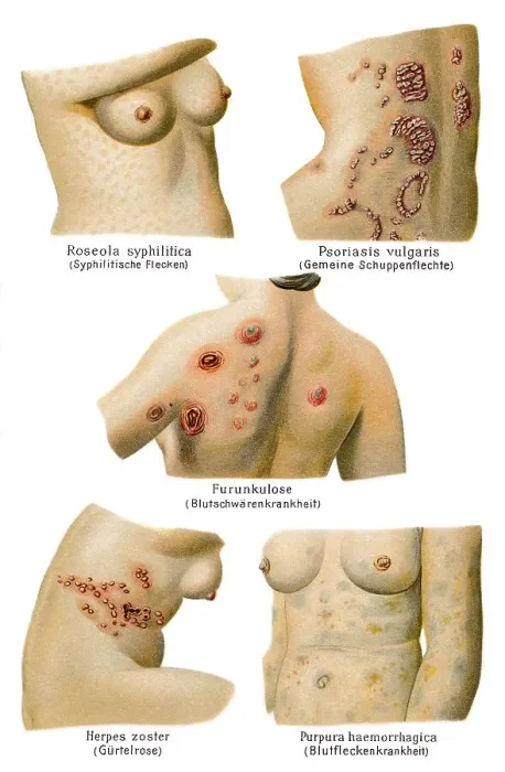 Framed Print : Skin diseases, 19th Century health guide illustration